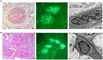 Daratumumab in the treatment of C3 glomerulopathy with monoclonal gammopathy: a case report and literature review